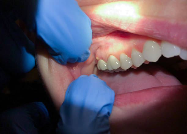 Best Emergency Root Canal Treatment in Alliae, NC