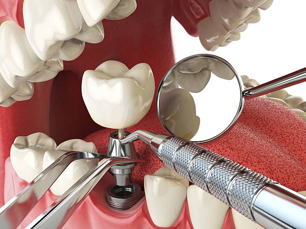 Best Emergency Wisdom Teeth Removal in Alliae, NC